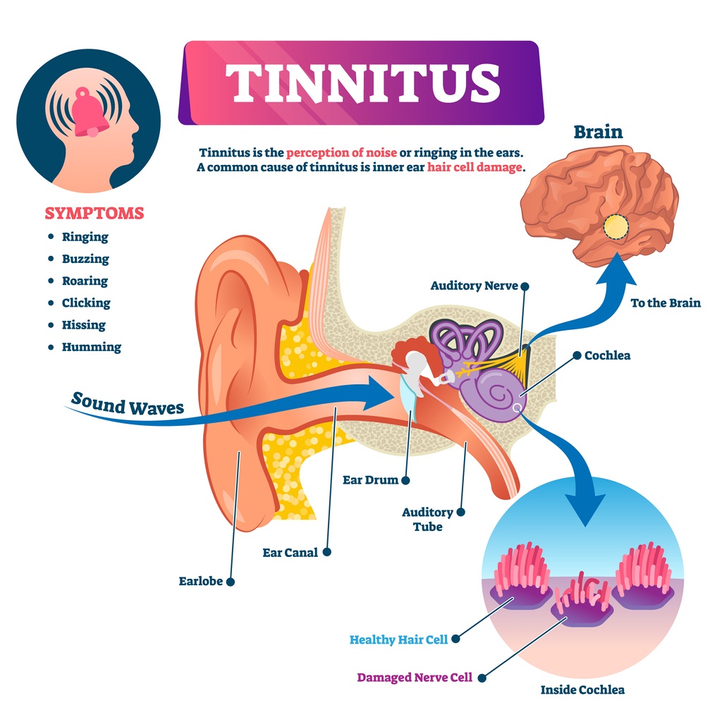 ear diagram showing the cause of tinnitus
