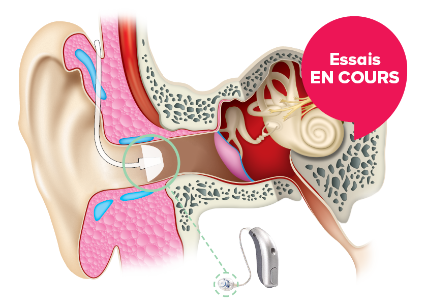 Hearinglife Remarkable New Hearing Aid Now Available