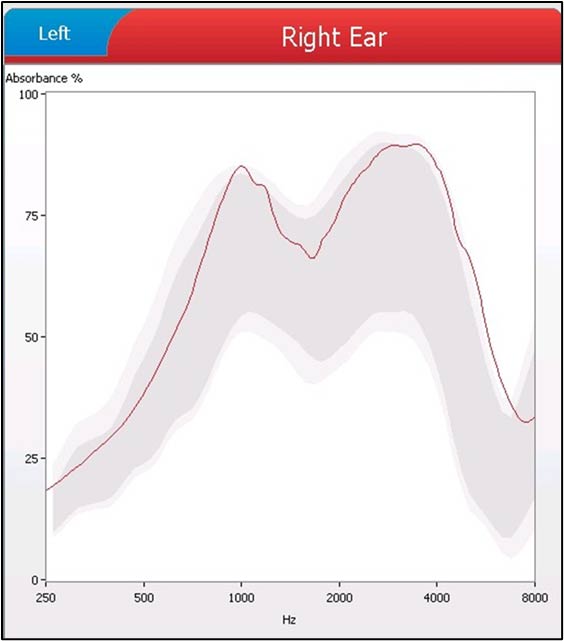 wideband tympanometry example right ear