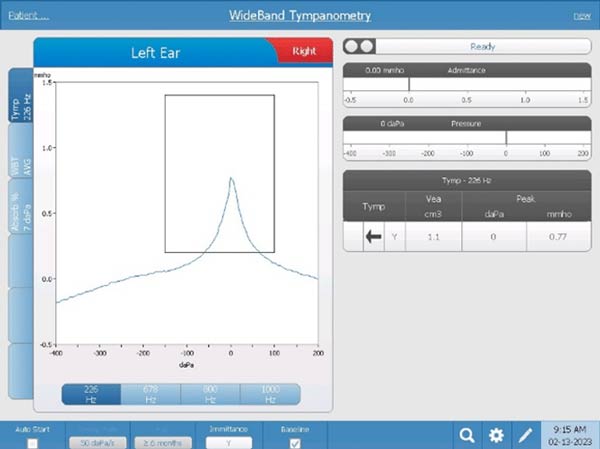wide band tympanometry left ear example