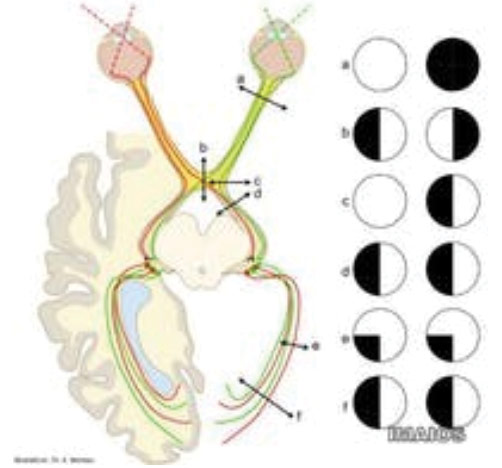 braininjury01