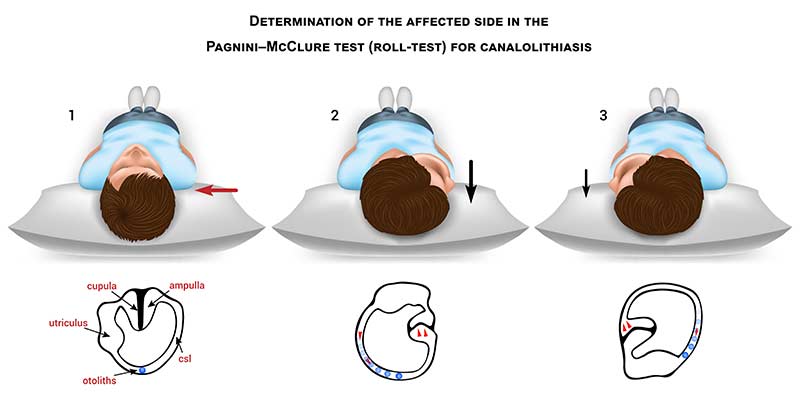 pagnini mcclure test