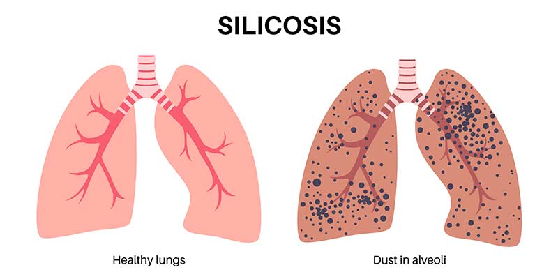 silicosis of lungs