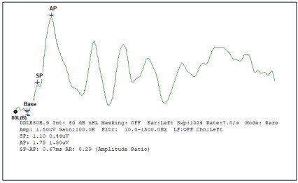 SP/AP Amplitude Ratio Graph