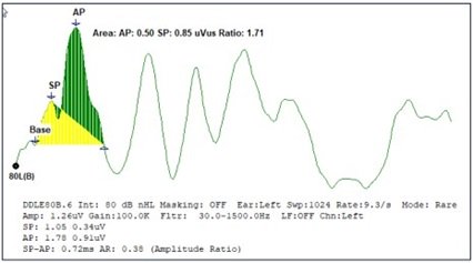 SP/AP Area Ratio Graph
