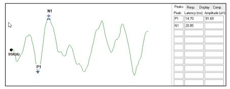 cVEMP Waveform Graph
