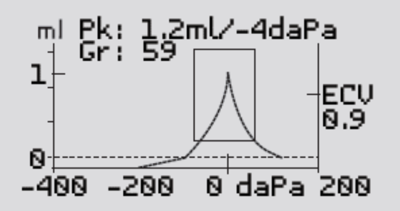tympanogram with normal peak