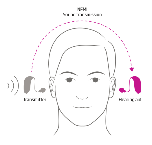 Oticon CROS & BiCROS Hearing Aid L Unilateral Hearing Loss L Oticon